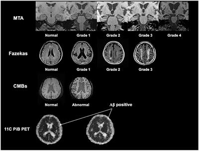 Alzheimer's disease pathology: pathways between chronic vascular risk factors and blood-brain barrier dysfunction in a cohort of patients with different types of dementia